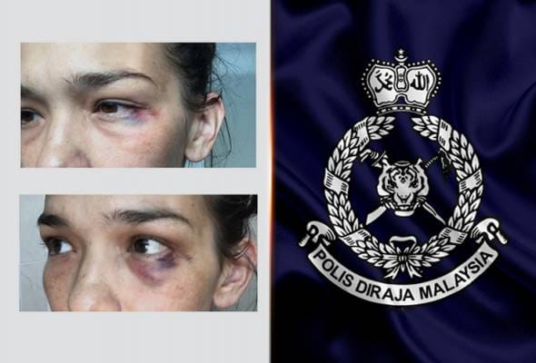 Zahnita Wilson muat naik wajah lebam, suami sudah ditahan polis