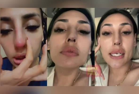 Zarina Anjoulie menyesal 'buat hidung', pembedahan plastik guna silikon terpakai